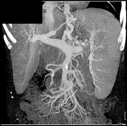 Cirrhosis With Varices - CTisus CT Scan