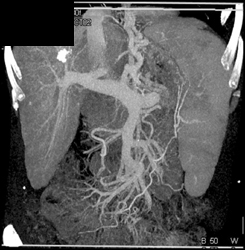 Cirrhosis With Varices - CTisus CT Scan