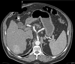 Hepatoma in A Cirrhotic Liver - CTisus CT Scan