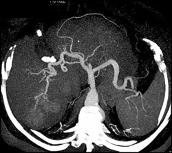 CTA Hepatoma- See Prior Set of Images - CTisus CT Scan