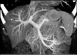 Cirrhosis - CTisus CT Scan