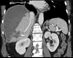 Subcapsular Hematoma With Laceration - CTisus CT Scan