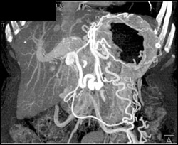 Cirrhosis With Hepatocellular Carcinoma (HCC) and Varices - CTisus CT Scan