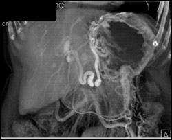 Cirrhosis With Varices - CTisus CT Scan