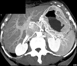 Tumor Invades Portal Vein - CTisus CT Scan