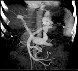 Cirrhosis With Varices - CTisus CT Scan