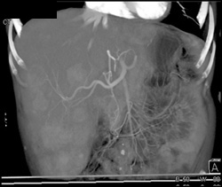 Normal Hepatic Artery - CTisus CT Scan