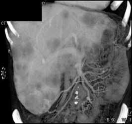 Liver Metastases - CTisus CT Scan