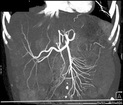 Enlarged Liver With Hypovascular Metastases - CTisus CT Scan