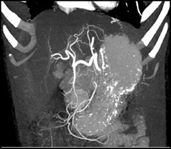 Cirrhosis - CTisus CT Scan