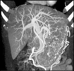 Cirrhosis With Varices - CTisus CT Scan