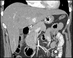 Hemangioma - CTisus CT Scan