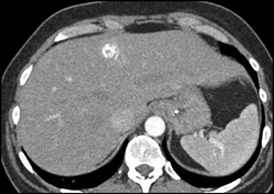 Hemangioma - CTisus CT Scan