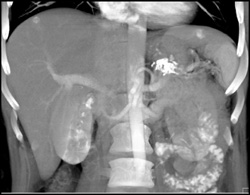 Hemangioma - CTisus CT Scan