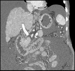 Cirrhosis - CTisus CT Scan