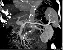 Cirrhosis With Varices - CTisus CT Scan