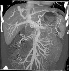 Cirrhosis With A-v Fistulae Liver - CTisus CT Scan