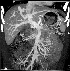 Av Fistulae in Dome of Liver - CTisus CT Scan