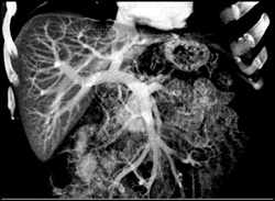 MIP Vs. VRT - CTisus CT Scan