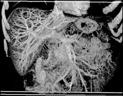 Opaque VRT of Normal Liver - CTisus CT Scan