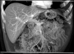 Two Normal VRTs of the Liver - CTisus CT Scan