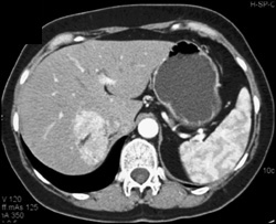 Angiomyolipoma of the Liver With Central Fat - CTisus CT Scan