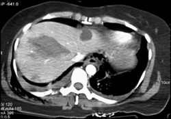 Liver Laceration - CTisus CT Scan