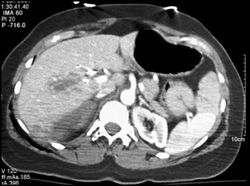 Liver Laceration - CTisus CT Scan