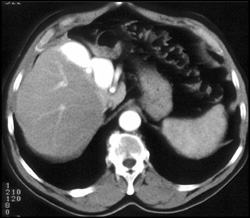 Hepatic Artery- Hepatic Vein Fistulae - CTisus CT Scan