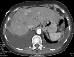 Vascular Mets to Liver - CTisus CT Scan