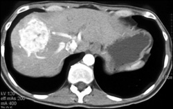 Metastatic Carcinoid to the Liver - CTisus CT Scan