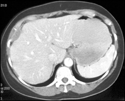 Implants on the Liver Surface - CTisus CT Scan