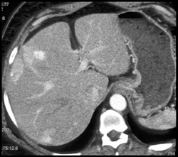 Liver Metastases - CTisus CT Scan