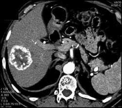 Hemangioma - CTisus CT Scan