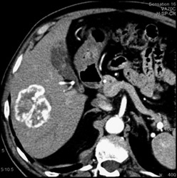 Hemangioma - CTisus CT Scan