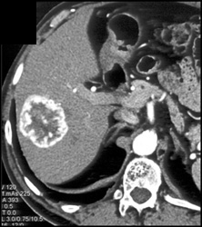 Hemangioma - CTisus CT Scan