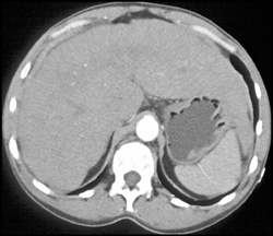 Cirrhosis With Nodes - CTisus CT Scan