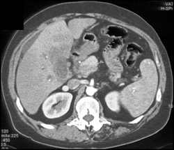 Cholangiocarcinoma - CTisus CT Scan