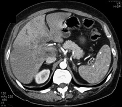 Cholangiocarcinoma - CTisus CT Scan