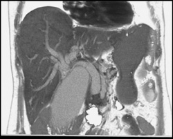 Courvosiers Gallbaldder - CTisus CT Scan