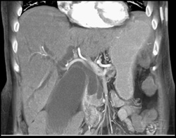 Ampullary Cancer - CTisus CT Scan