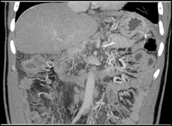 Calcified Portal Vein and Splenic Vein - CTisus CT Scan