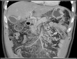 Collaterals in Mesenteric Vein - CTisus CT Scan