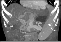 Cirrhosis With Varices - CTisus CT Scan