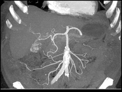 Hemangioma - CTisus CT Scan