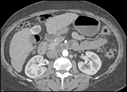 Hemangioma - CTisus CT Scan