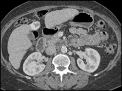 Hemangioma - CTisus CT Scan