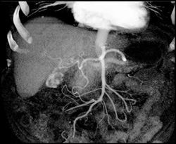 Hemangioma - CTisus CT Scan