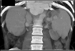 Cirrhosis With Varices - CTisus CT Scan