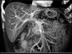 VRT/MIP Liver - CTisus CT Scan